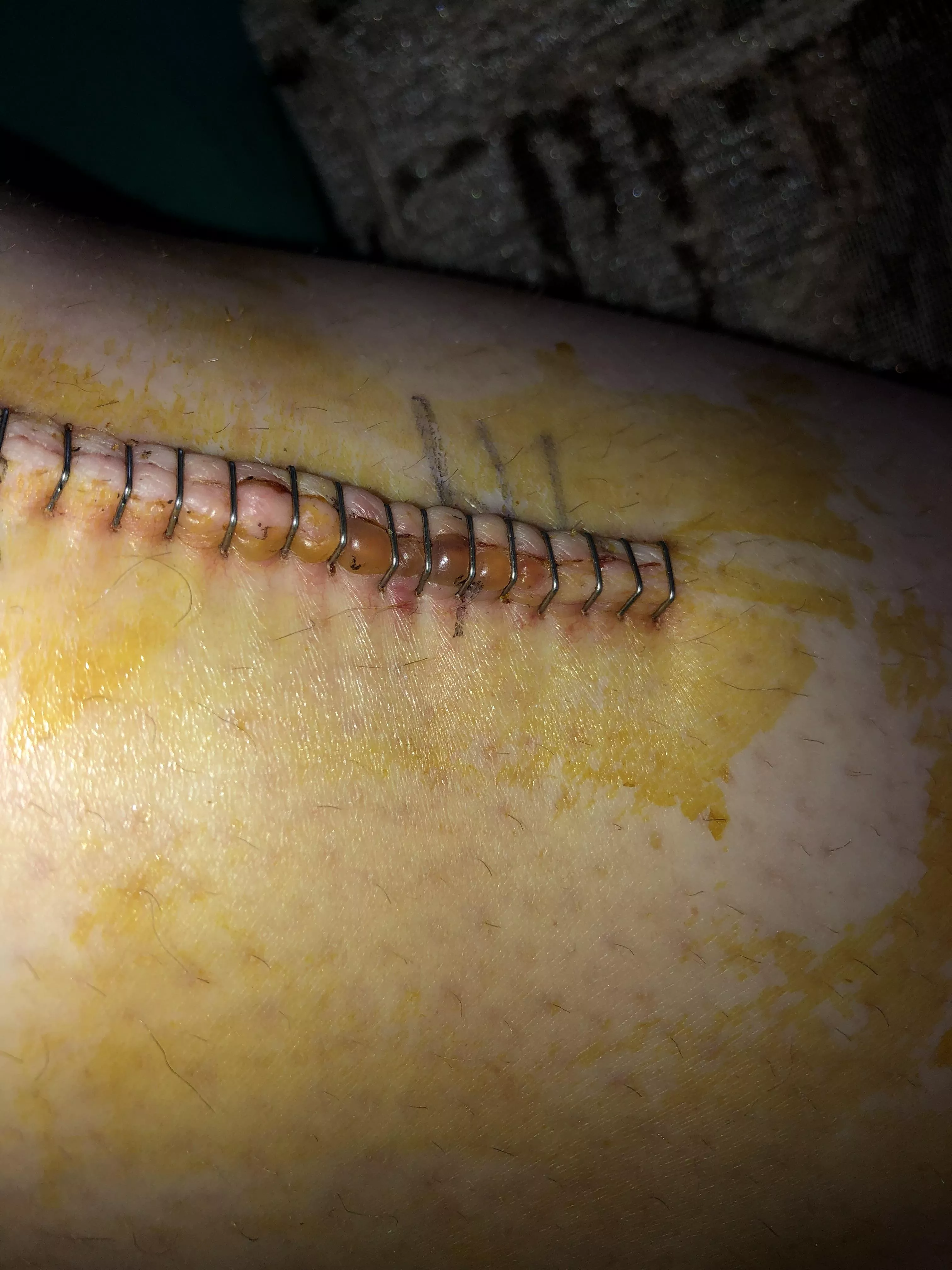 Forbidden pop of the fluid under my skin between the surgical staples on an incision. posted by UnfocusedCowgirl
