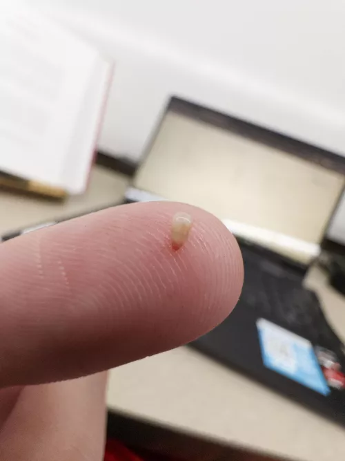 Just yoinked this little guy out of my back by CrispyHoneyBeef