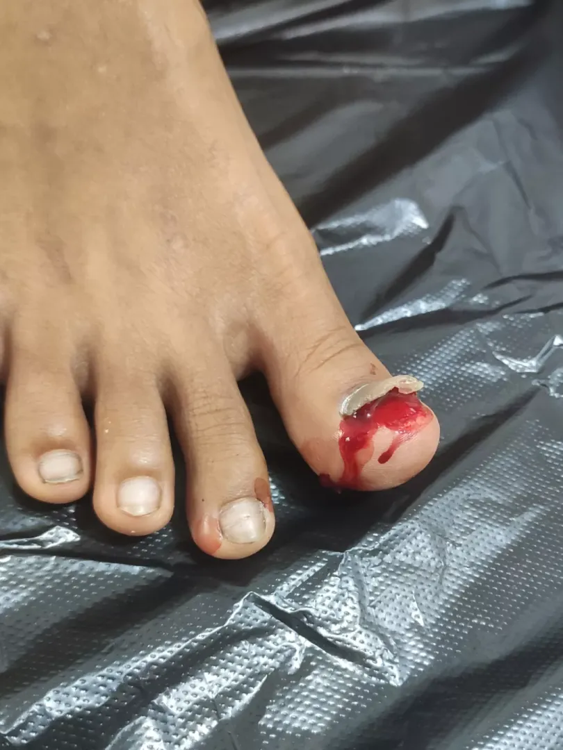 Accidental Nail avulsion  by demen7or