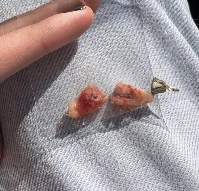 Dentist broke my tooth.  posted by KillNik
