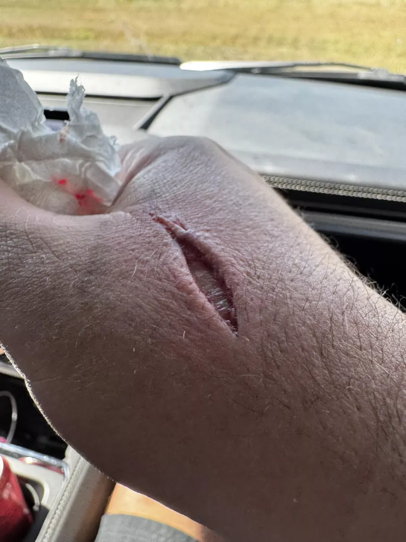 Got bit by a 45 posted by MSTFMBM
