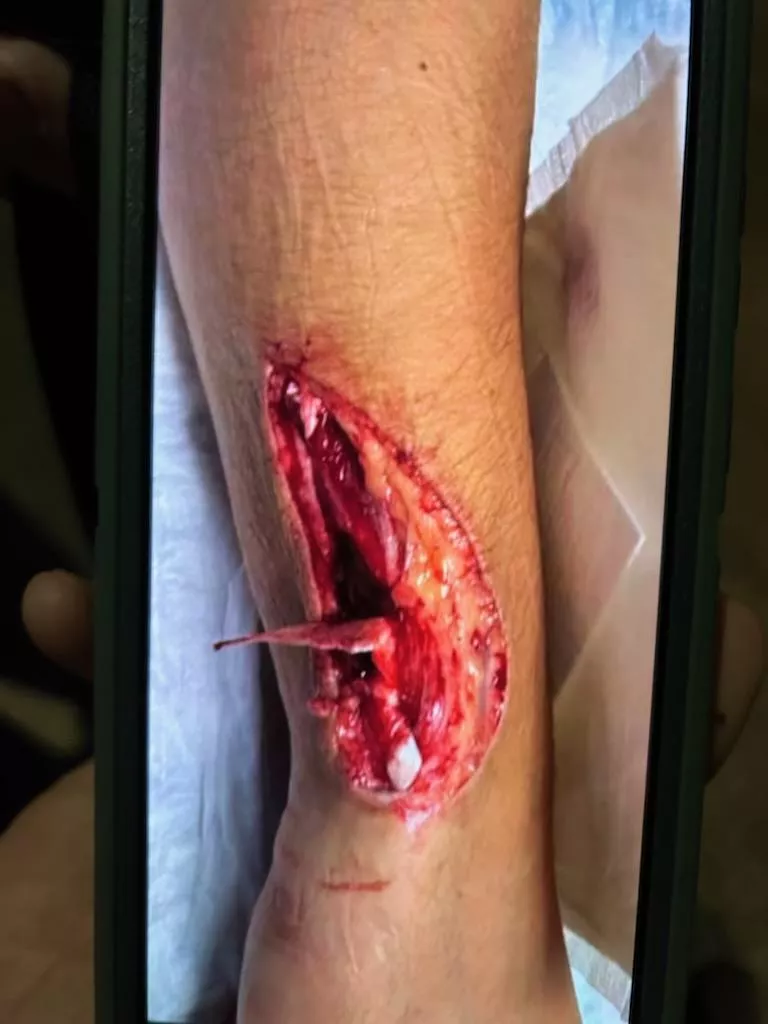 Shattered window pane at work slices apprentice glaziers arm. posted by SaltySauceMook