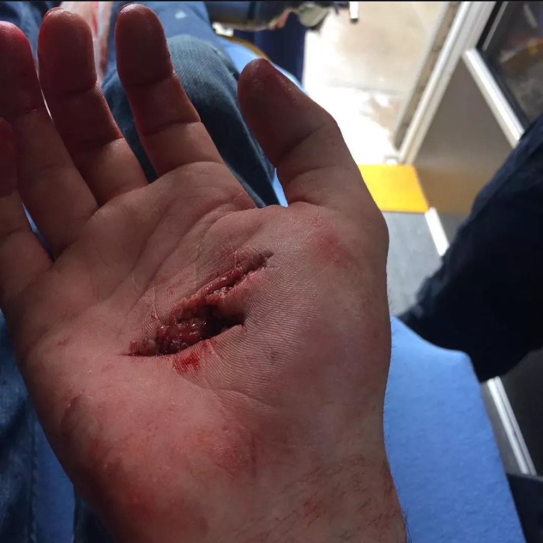 Sliced my hand open on a Starbucks bottle.  by Character_Lab_8817