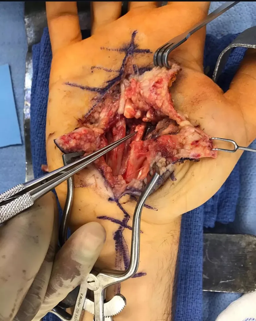 Surgery photos of my sliced hand.  by Character_Lab_8817
