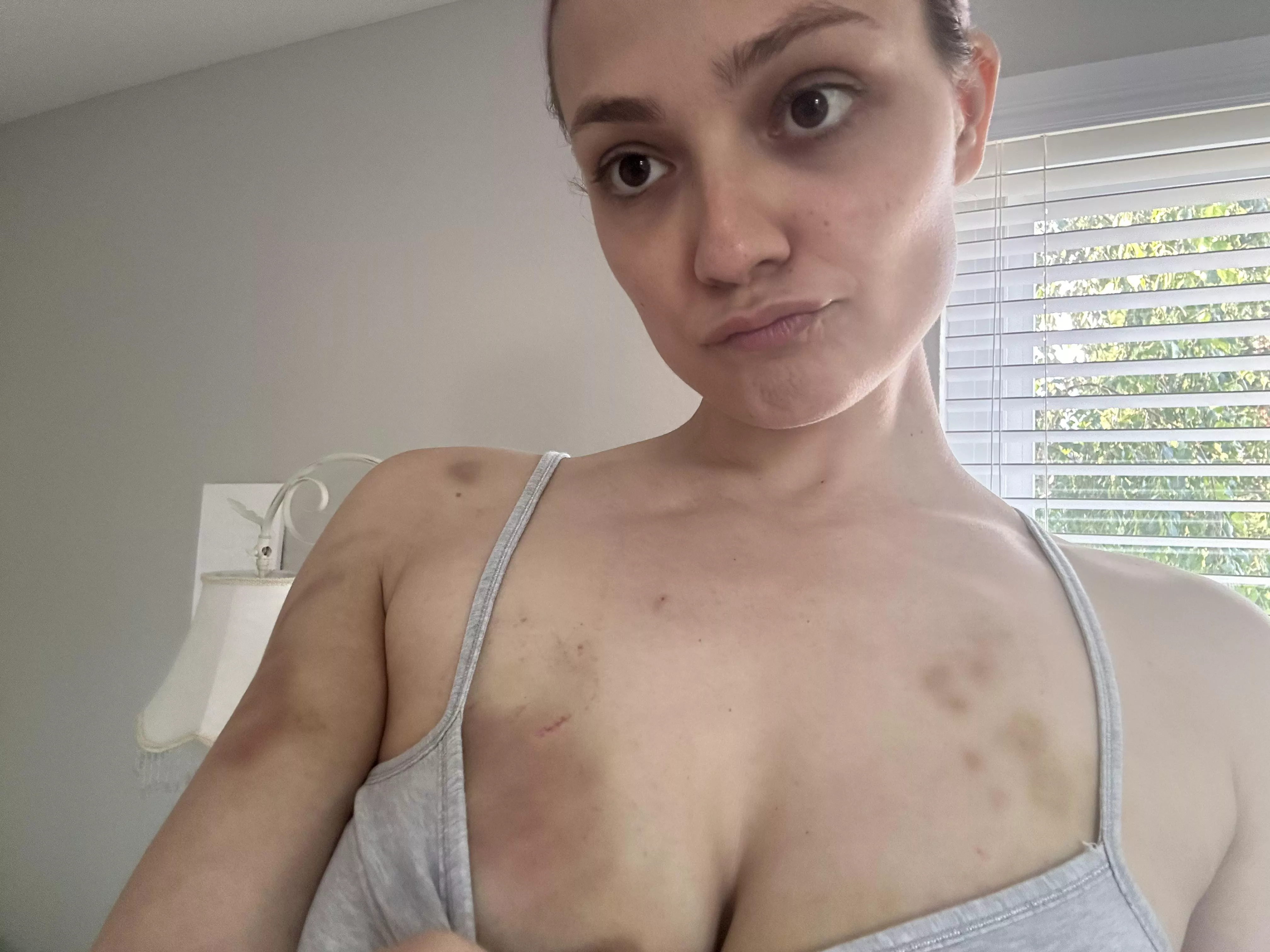 Bruised up girly posted by ShiftAccomplished579