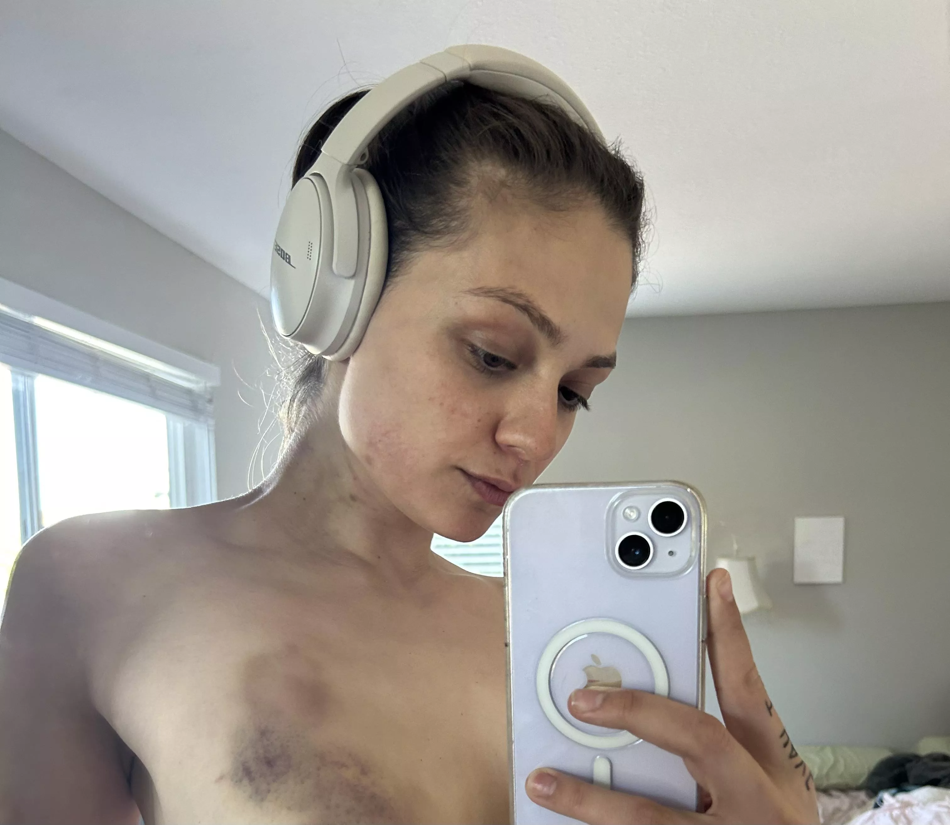 my bruises make me feel beautiful posted by ShiftAccomplished579