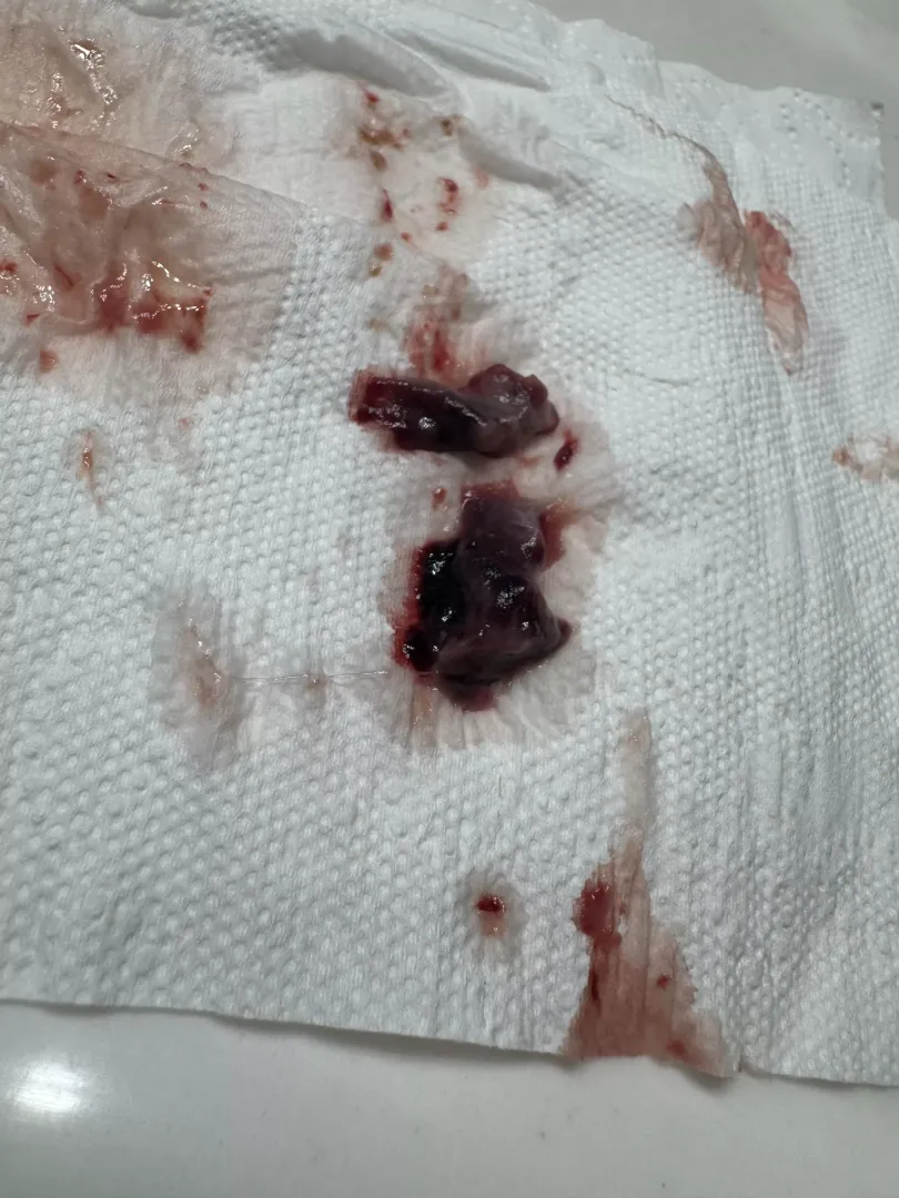 I had nose/ sinuse surgery, this came out of my nose today posted by JCwraps