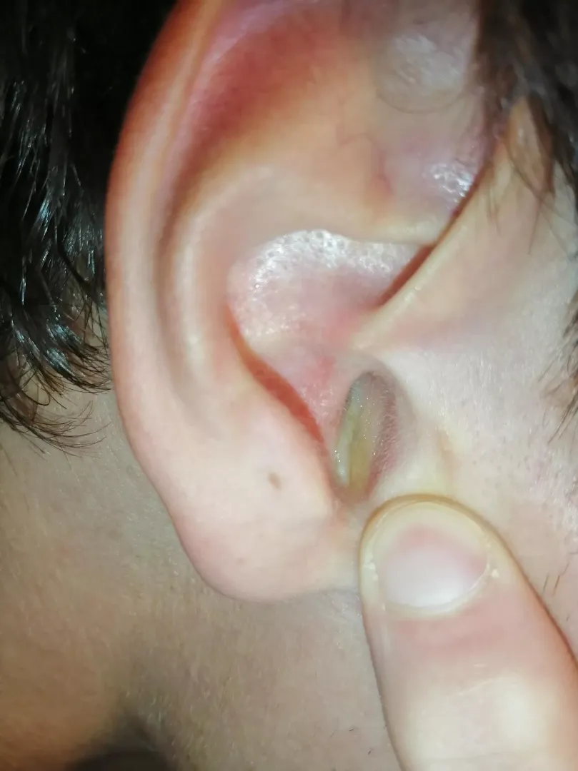 Otitis infection by Europeanroadbycar