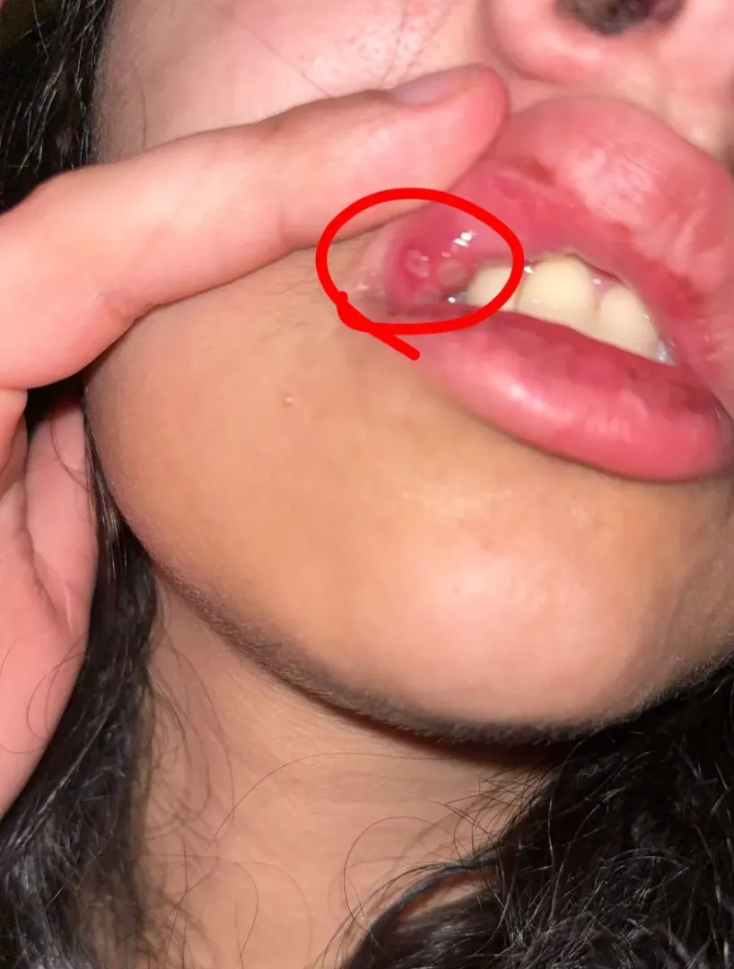 My biannual canker sores all in one spot posted by lemons_mama