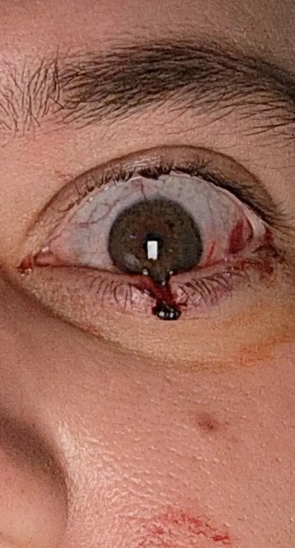 My cat cleaved open my eye posted by Sergeant_Insanity