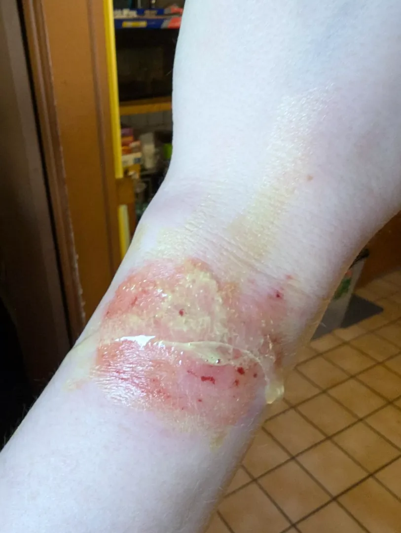 Smartwatch rash + fresh aloe vera from the garden = body horror by Brovigil