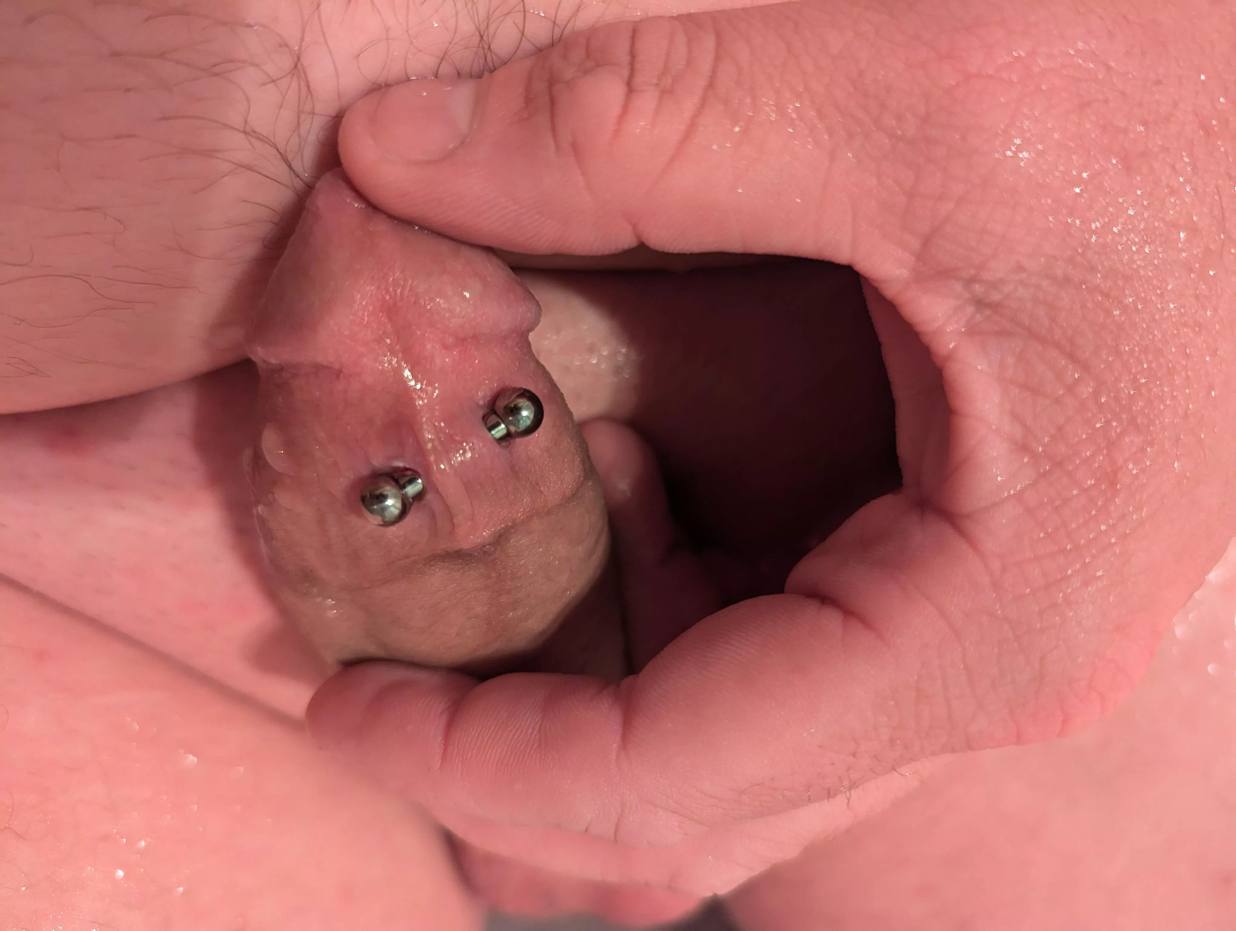 1 yo frenum posted by No-Push-5723