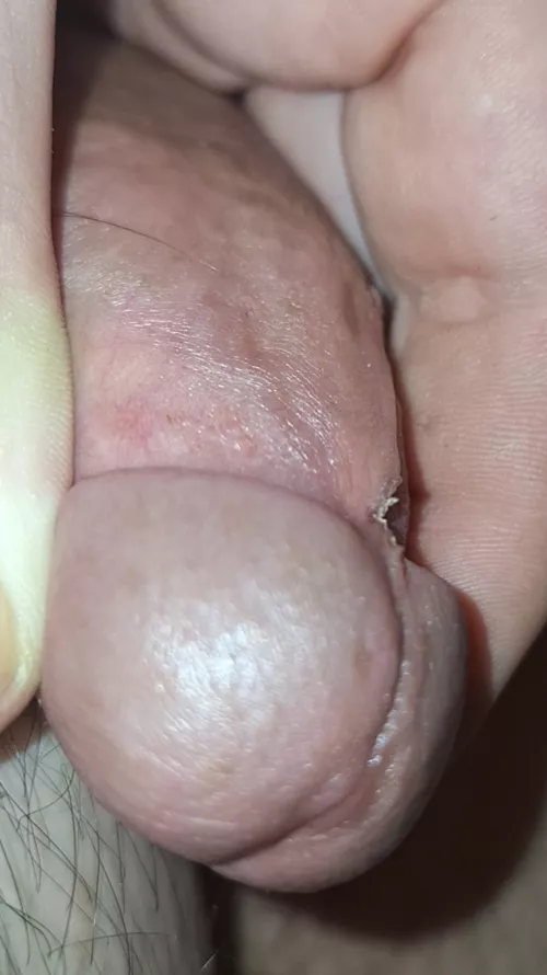 Frenulum snipped by ppheadjrs