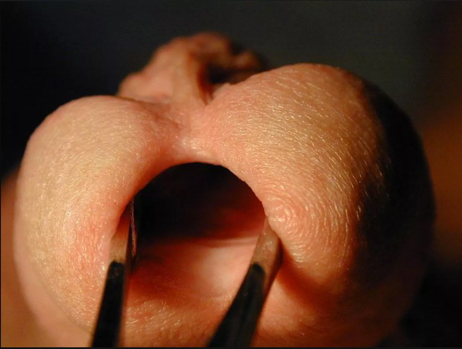 Partial meatotomy open posted by Cjps1243