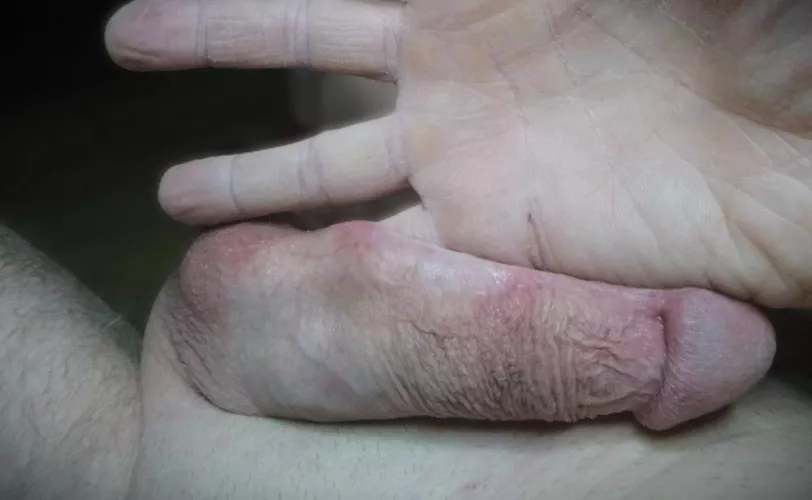 auricular sounding by cassoulem