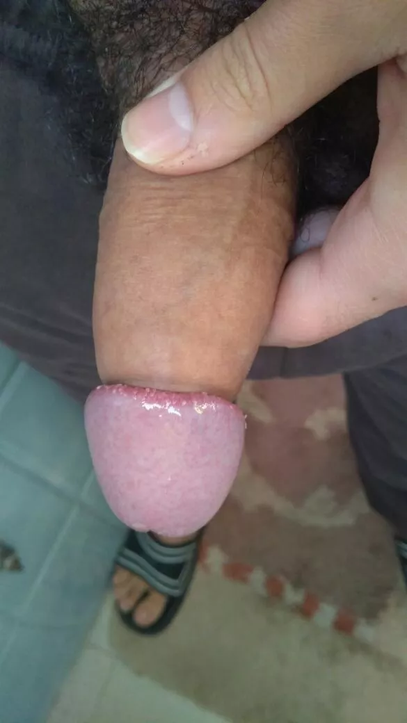 When my phimosis was really really intense! By the way it doesn't hurt as shown and it also gets very very sensitive!  posted by kgiann2021