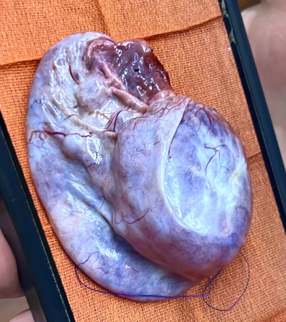 Basketball sized ovarian cyst 🏀 posted by hurricaneditka66