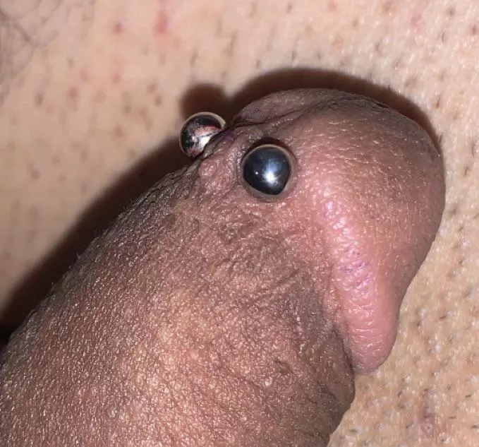 The first frenum almost 2 years ago. posted by Realistic_Sorbet_356