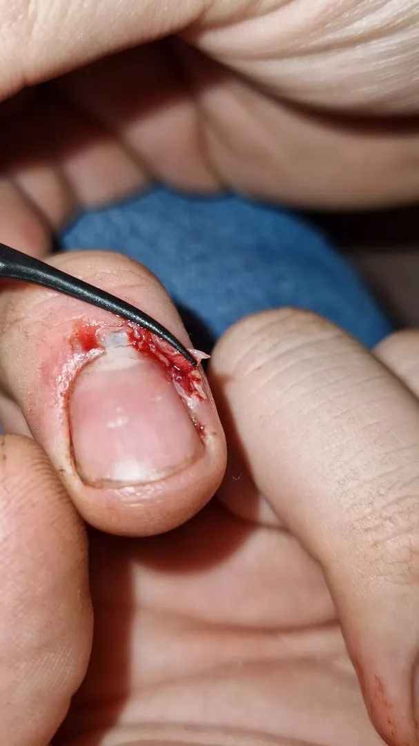 Drilled into my finger by Stain_This_Steel