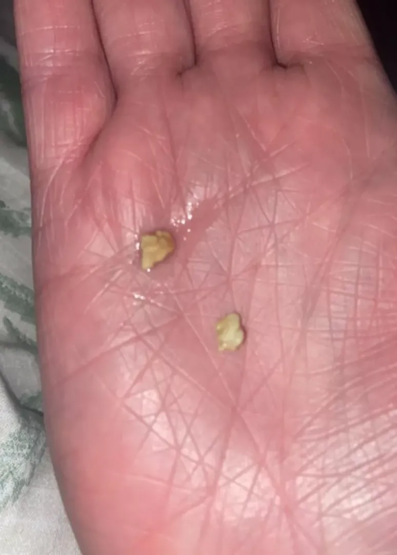 Huge Tonsil Stone posted by Ch3rry_br4t