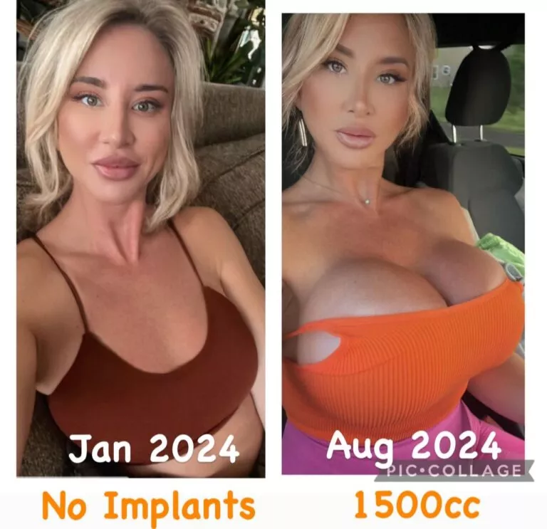 No implants in January, 1500cc by August posted by prezporn