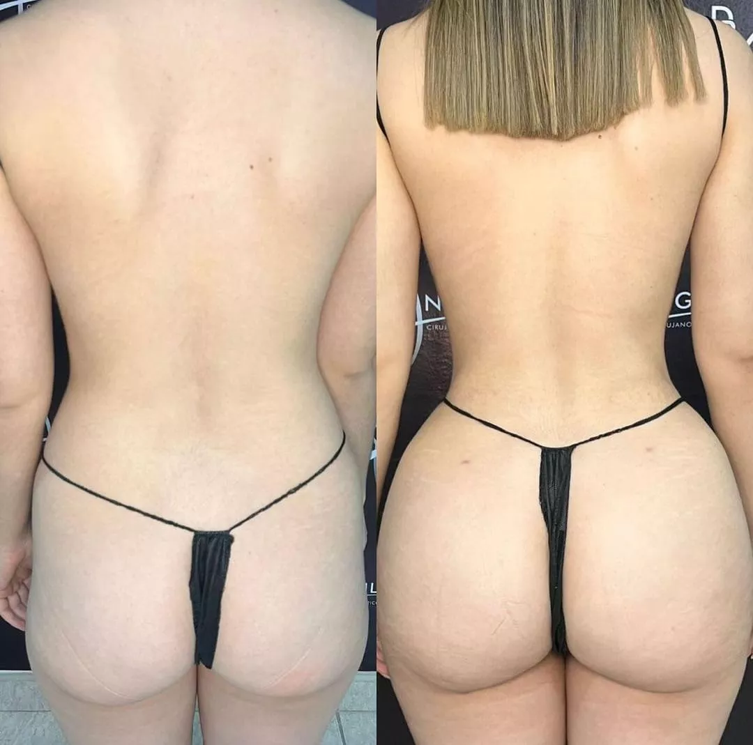 Before/after of liposuction 360 + BBL  posted by anonyyyymuser