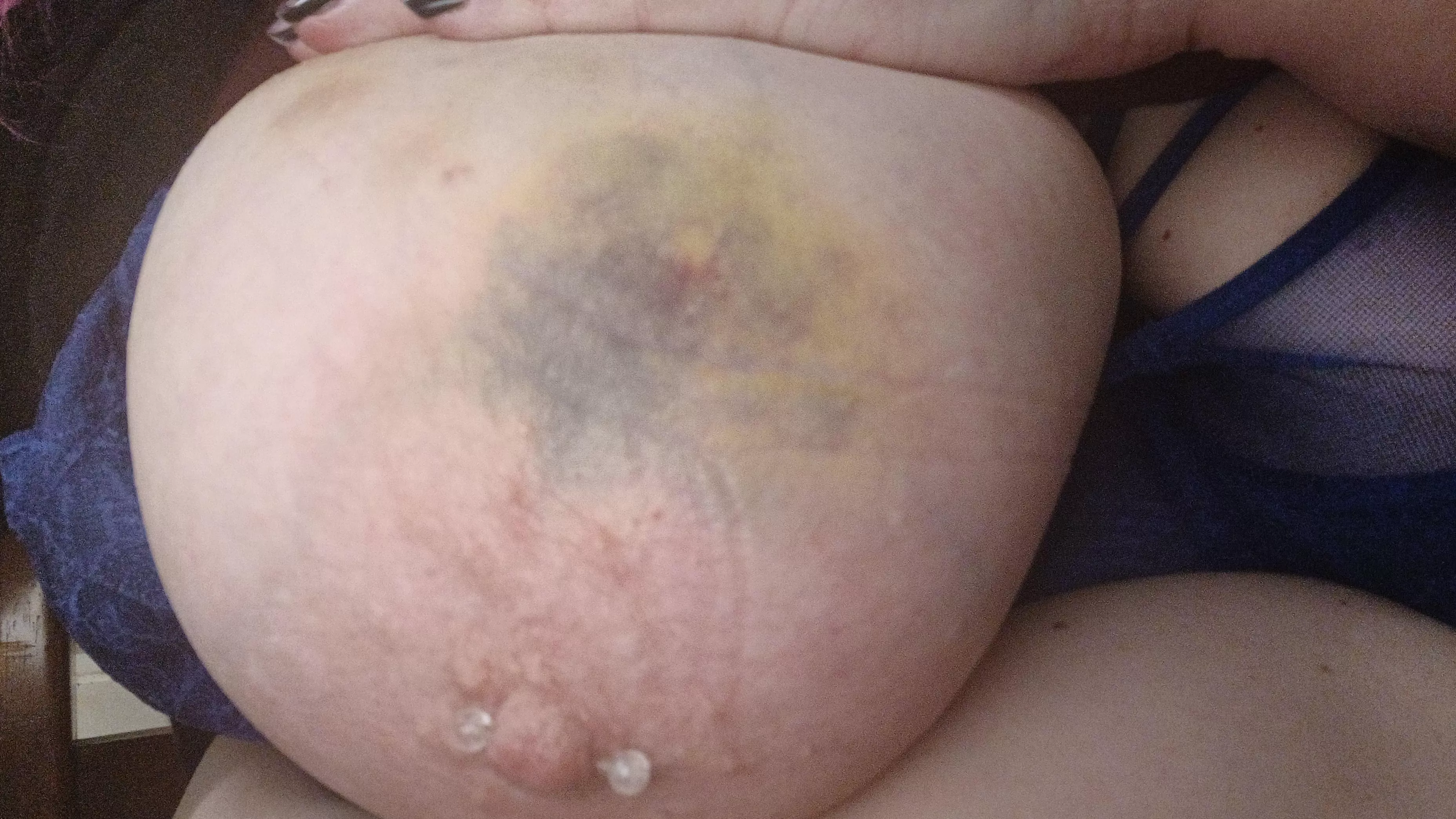 1 week old bruises....pretty!🥰 posted by BSweets66