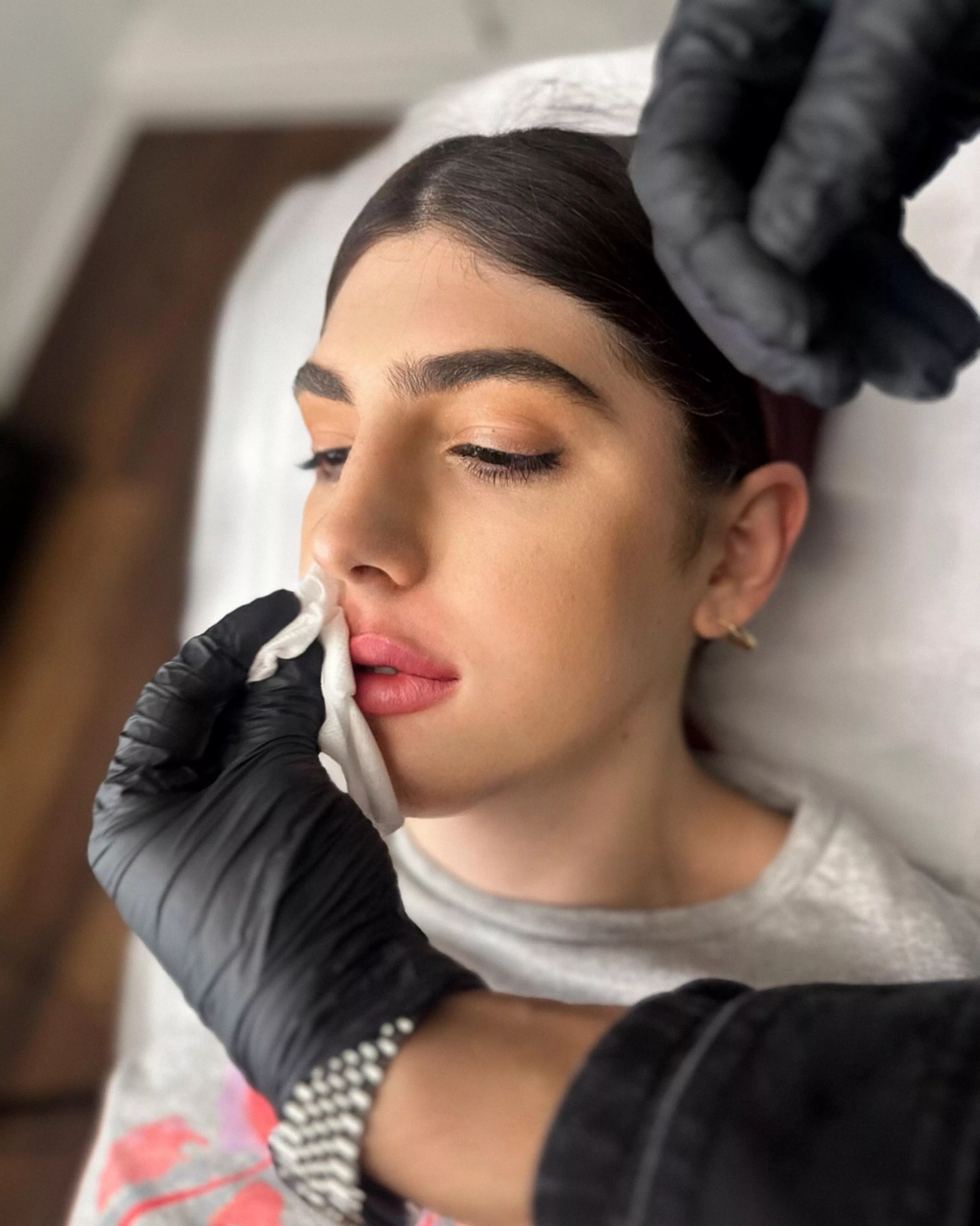 Finally lip fillers! What else should I get done? posted by the_ashlushy