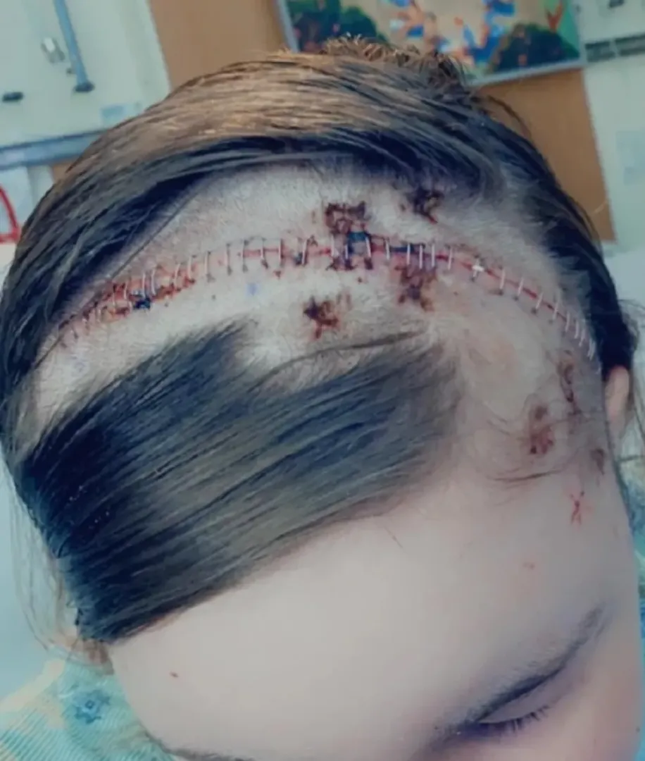 Older pic, but this was my first brain surgery (out of 4) posted by alienartissst