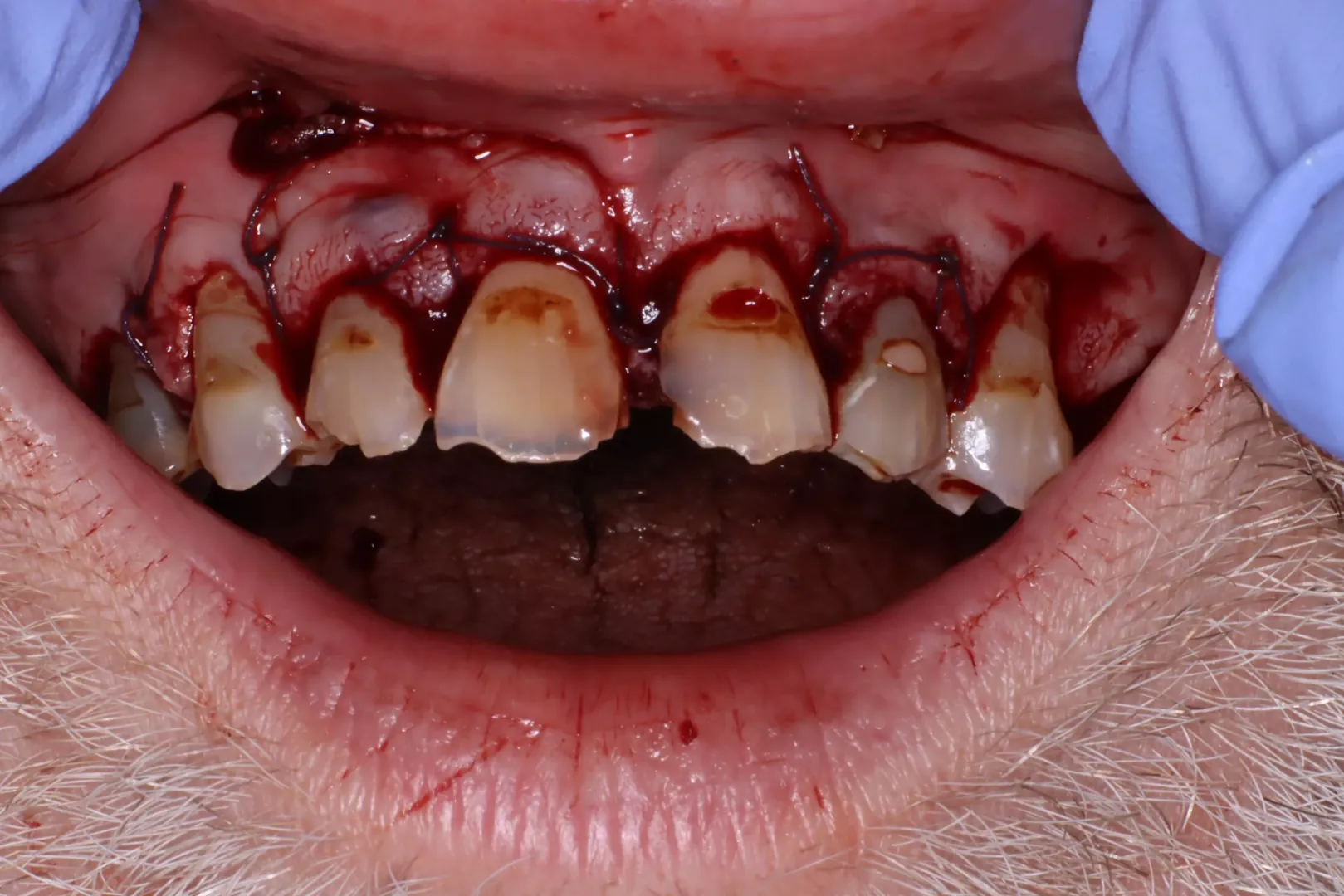Dental Surgery Yesterday ‘for My Own Good’ posted by HeldDownTooLong