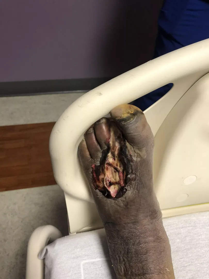 My dad’s bf might have his left foot removed.  posted by honeypesto