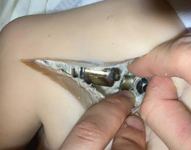 Who has any ideas? Fracture in the shoulder area by Proud_Carob_9623