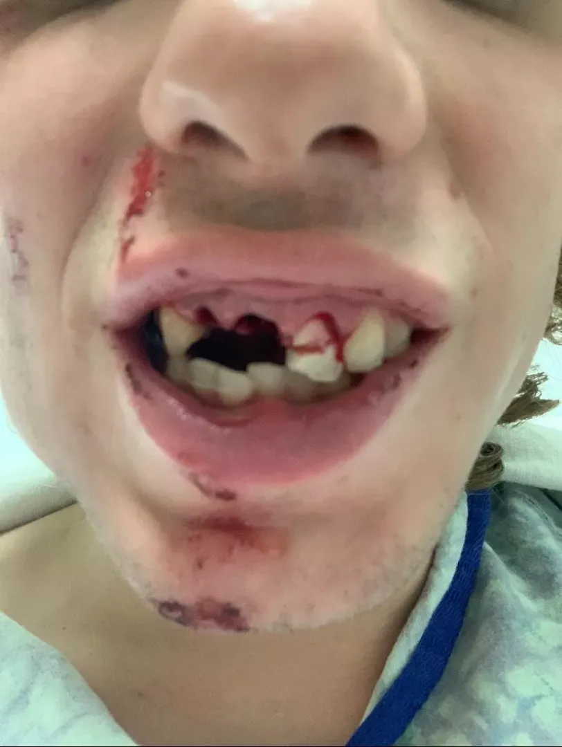 Jumped by 4 people, 3 teeth gone posted by BruhDeliveryGuy
