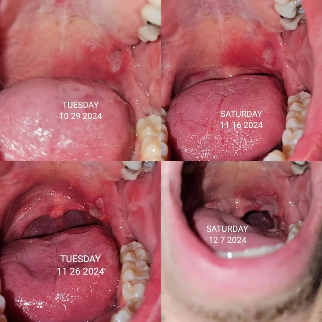 Canker sore from hell posted by TriggeredTherapist