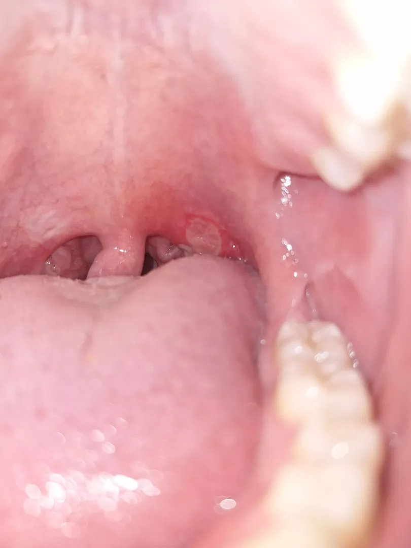 I too will post my canker sore from hell posted by Meniscuss2