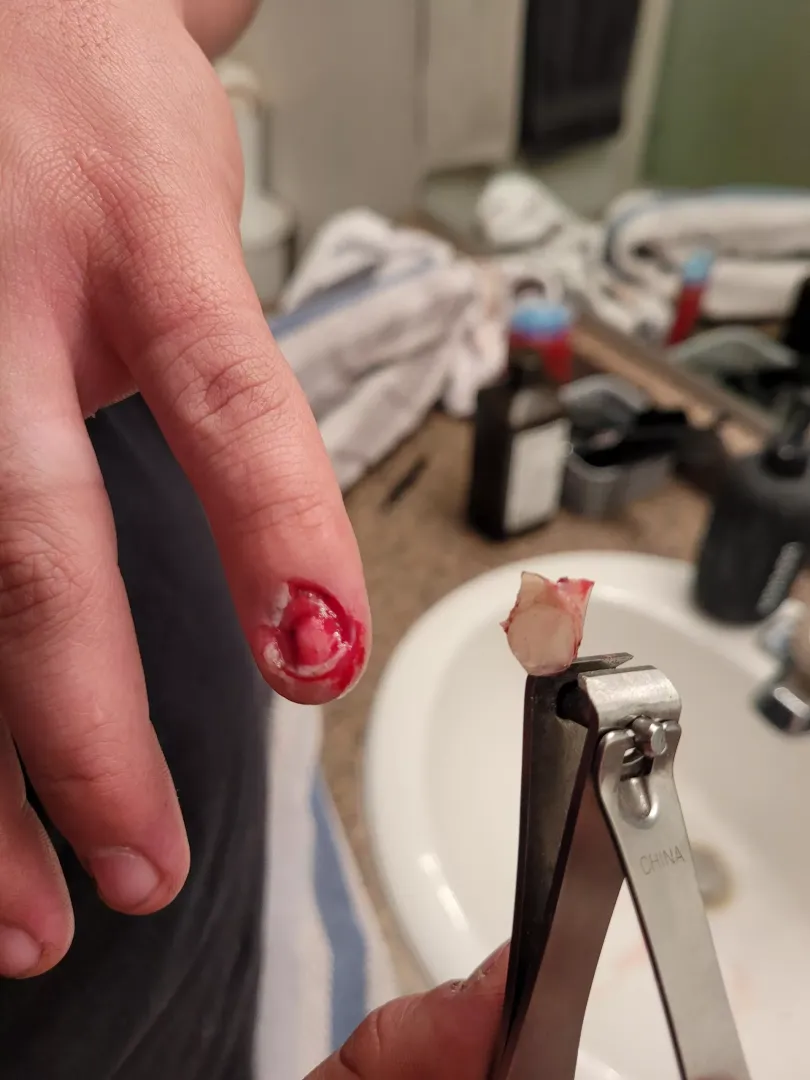 Pinky nail came right off posted by BlewDaeDae