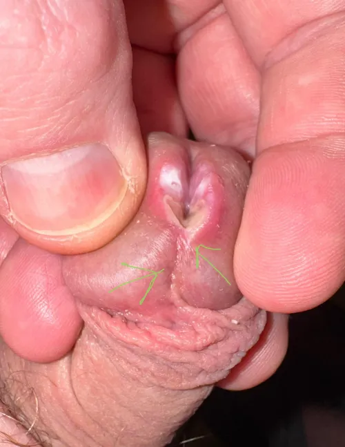 What line should I follow on my next cut for meatotomy?   You can see from photo I went a little off center on first cut with the cautery pen.   I want to do the full glans but want it to look nice.  Follow the line there? by No-Gazelle-1050