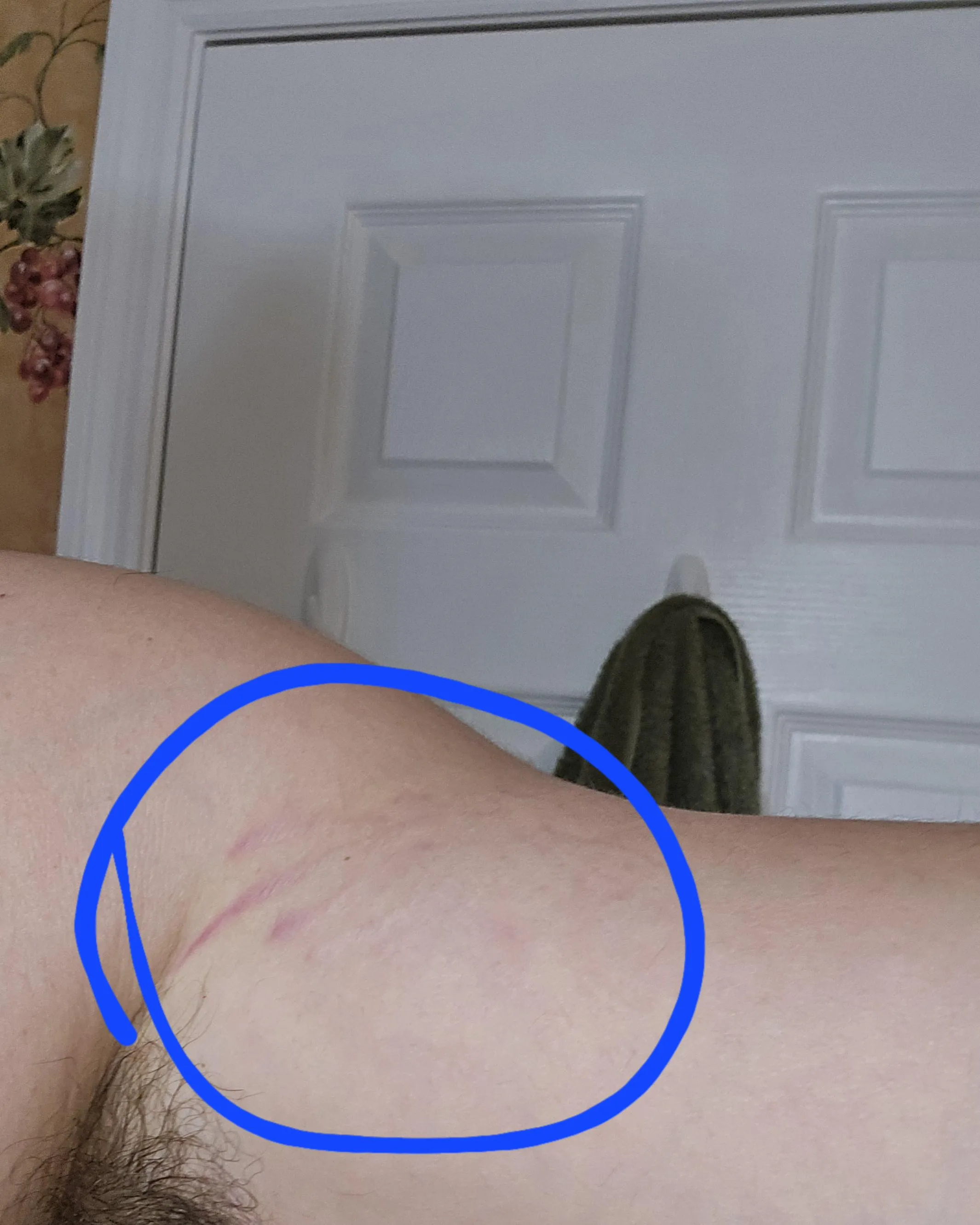 Stretch marks posted by Dry_Lawfulness1119