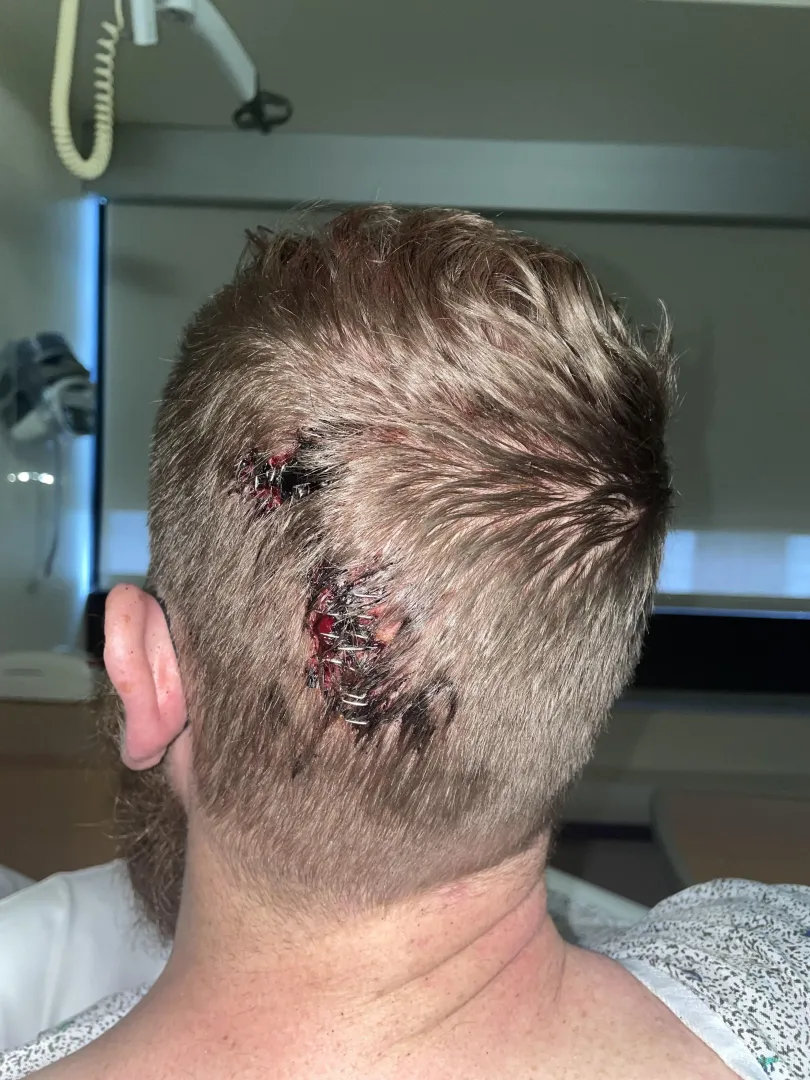 13 staples after drunken fall. by GritwaldGGrittington