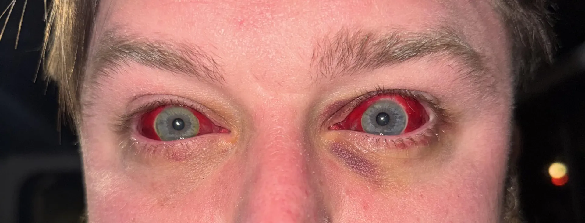 A lil ocular hemorrhage for your viewing posted by Fluffy-Bus-2529