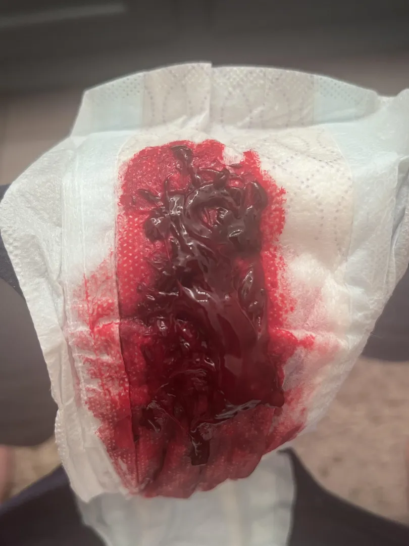Blood clot posted by Jolly-Ad7719