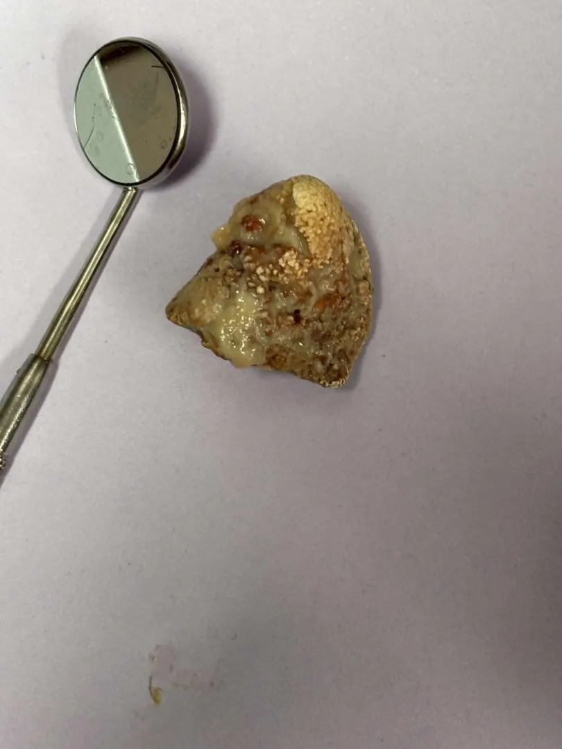 My friend said an old lady who doesn’t wash her teeth came into his dental office and had this in her mouth… posted by Hagstik4014