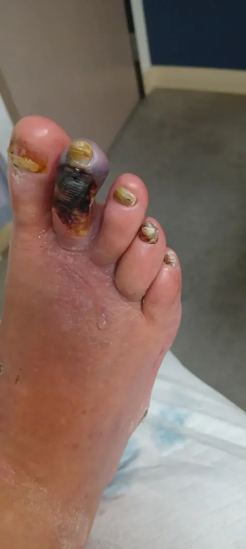 My grandpa dropped a log on his toe and didn't tell anyone for 3 months posted by PastyFreckledFace