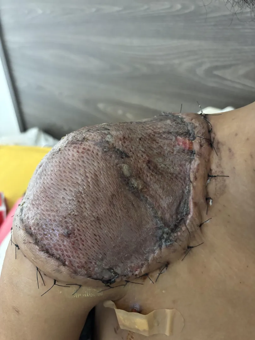 STSG Dermatofibrosarcoma posted by justlookingthere