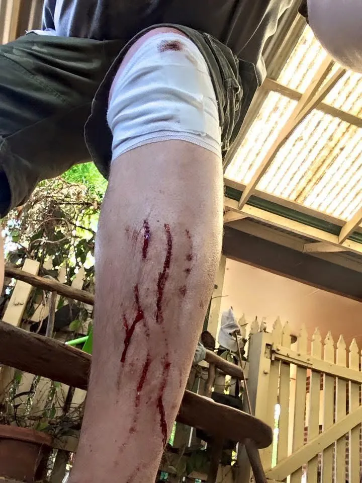 Bear swipe(not really, just an escalator wound) posted by Betty-Armageddon