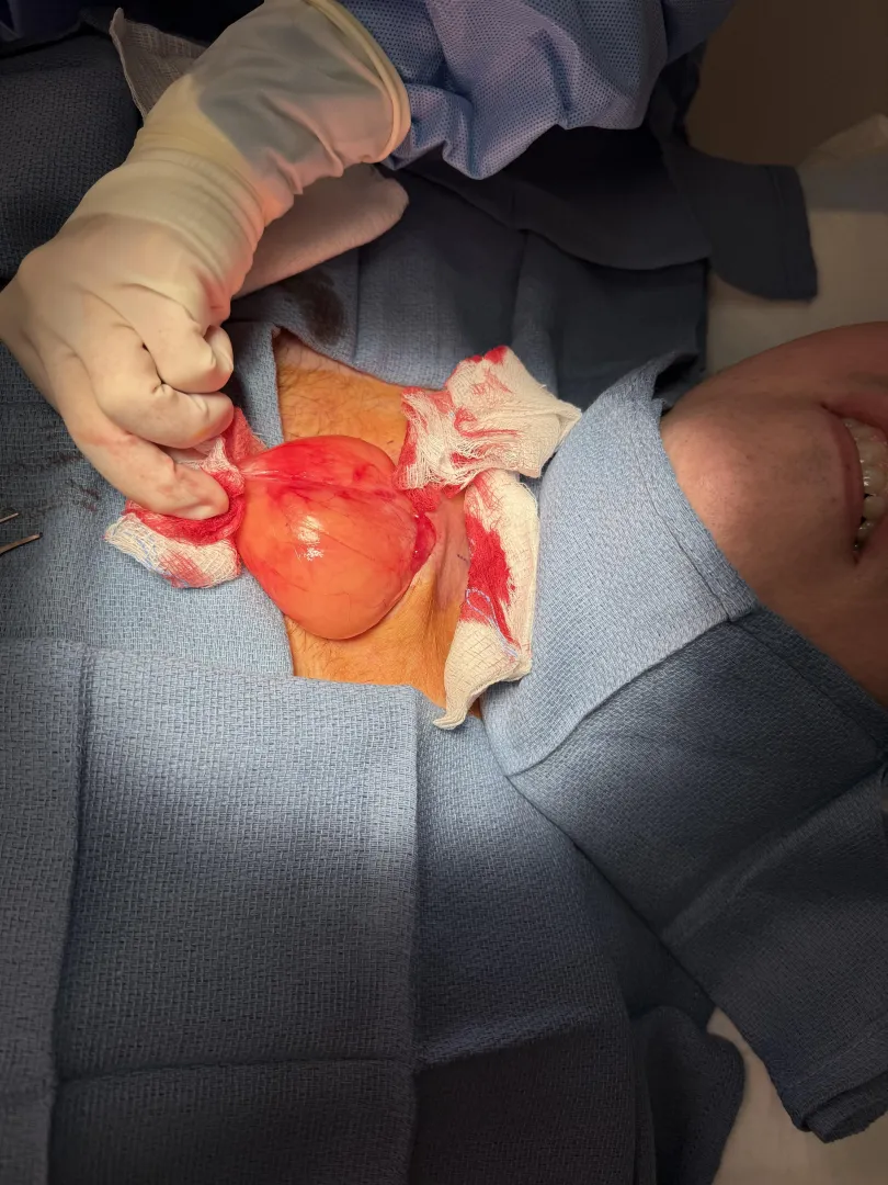 Had a massive Lymphoma removed from my neck while awake. posted by TheJTizzle