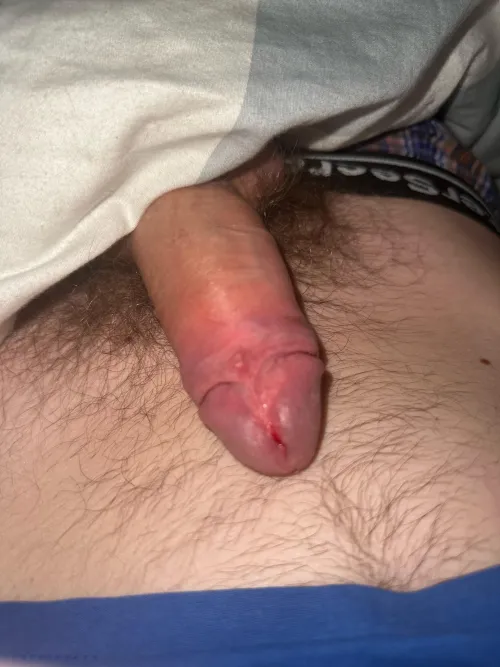 I just cut my frenulum and Im so happy I finally cut it by AffectionateLead59