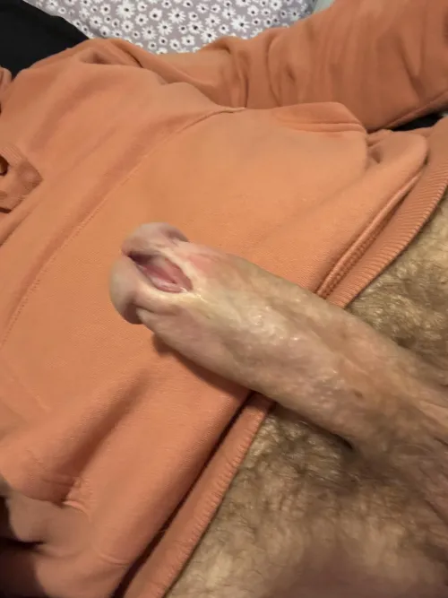 Never took pics of progress. Healed after 2nd cut by lovesounding