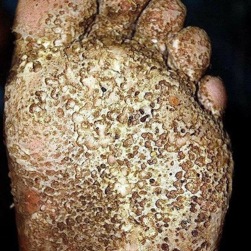 Pitted keratolysis posted by complex-sphere