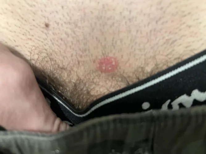 18M, Not sexually active. Red patch near groin area for about a month now. by NotAnAltAcc200